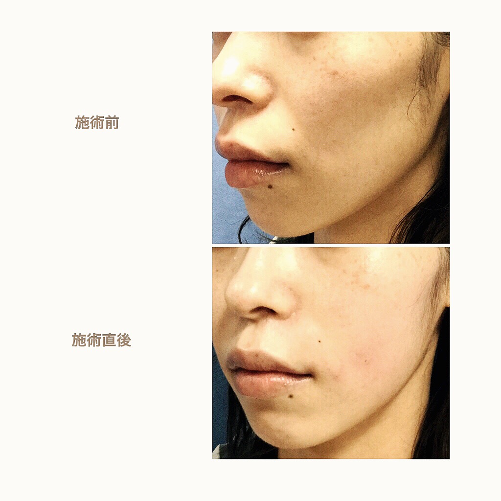 頬 が こけ てる