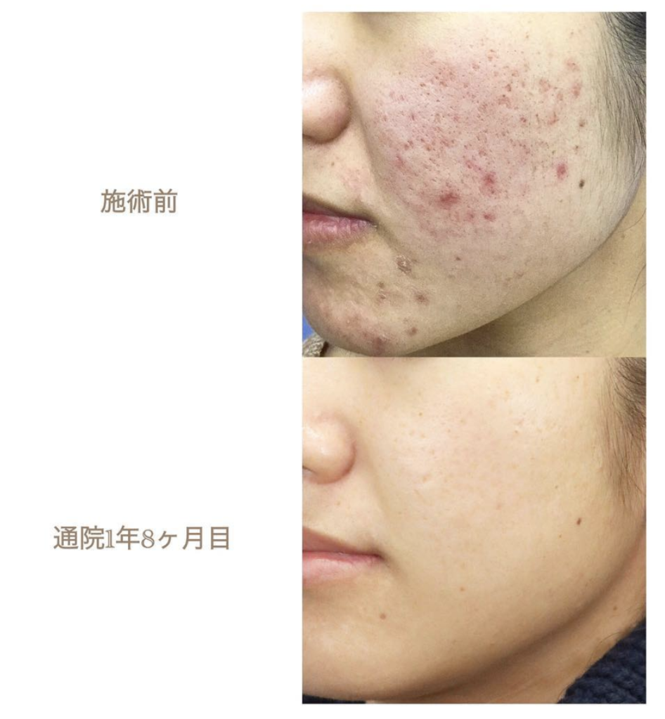 ニキビ治療をはじめて1年8ヶ月 すっぴん美肌をめざして 西川礼華 Official Blog