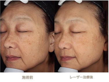 症例の紹介 鼻周りのくすみ シミのレーザー治療 西川礼華 Official Blog