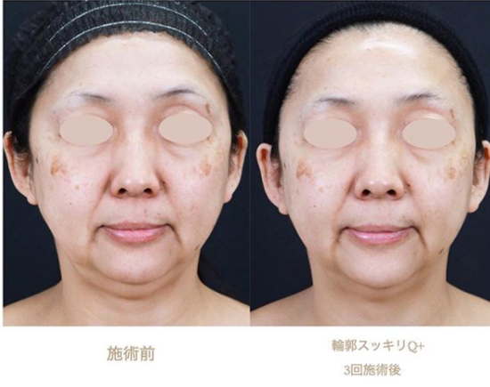 症例の紹介 たるみ治療の正面から見た変化 西川礼華 Official Blog