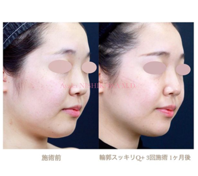 症例の紹介 注射を使わない小顔治療 輪郭スッキリq 西川礼華 Official Blog