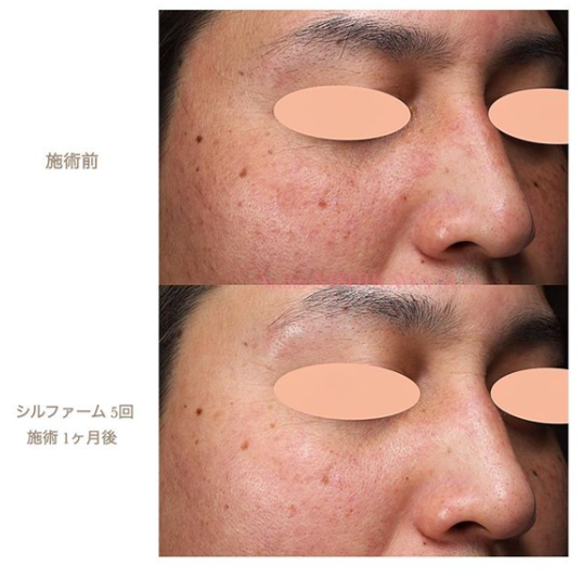 症例の紹介 男性の赤ら顔にももちろん効果あります 西川礼華 Official Blog